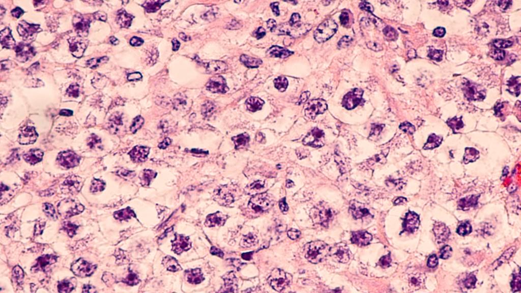 prostate cancer's tumor suppressor